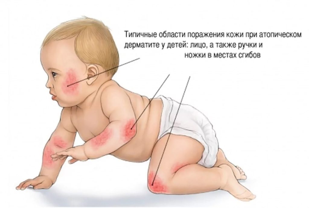 Симптоми дерматиту і способи лікування