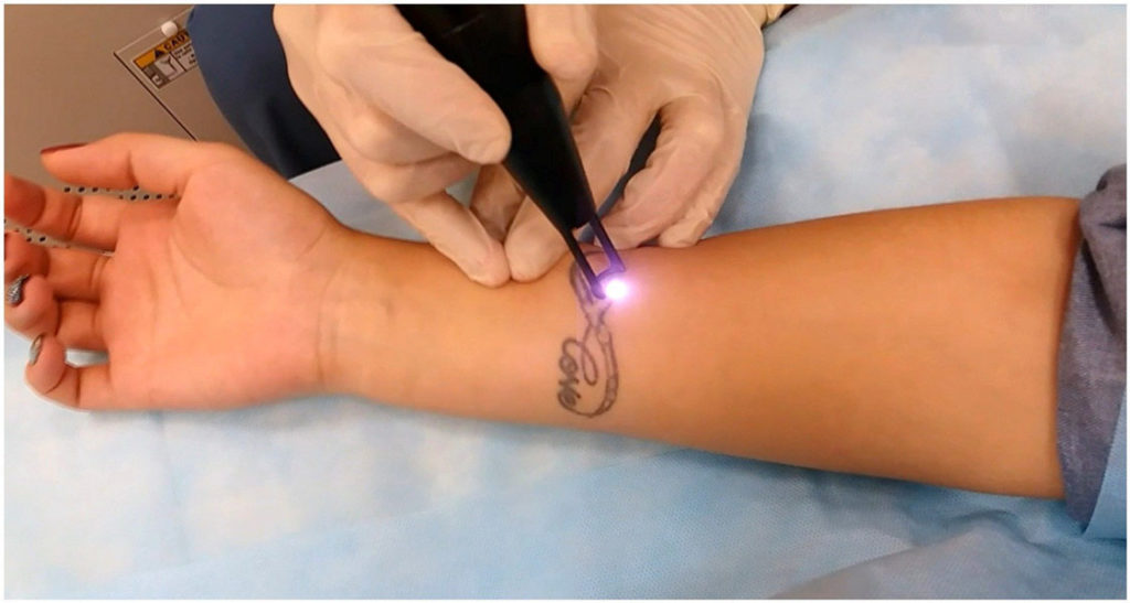 Важливі факти про зведення татуювань з шкіри, якими методами безпечніше й ефективніше це зробити?