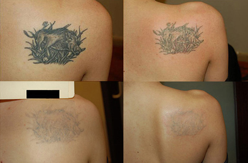 Важливі факти про зведення татуювань з шкіри, якими методами безпечніше й ефективніше це зробити?